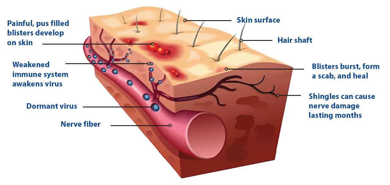 What Is Post Herpetic Neuralgia Or Pain After Shingles PMCOA